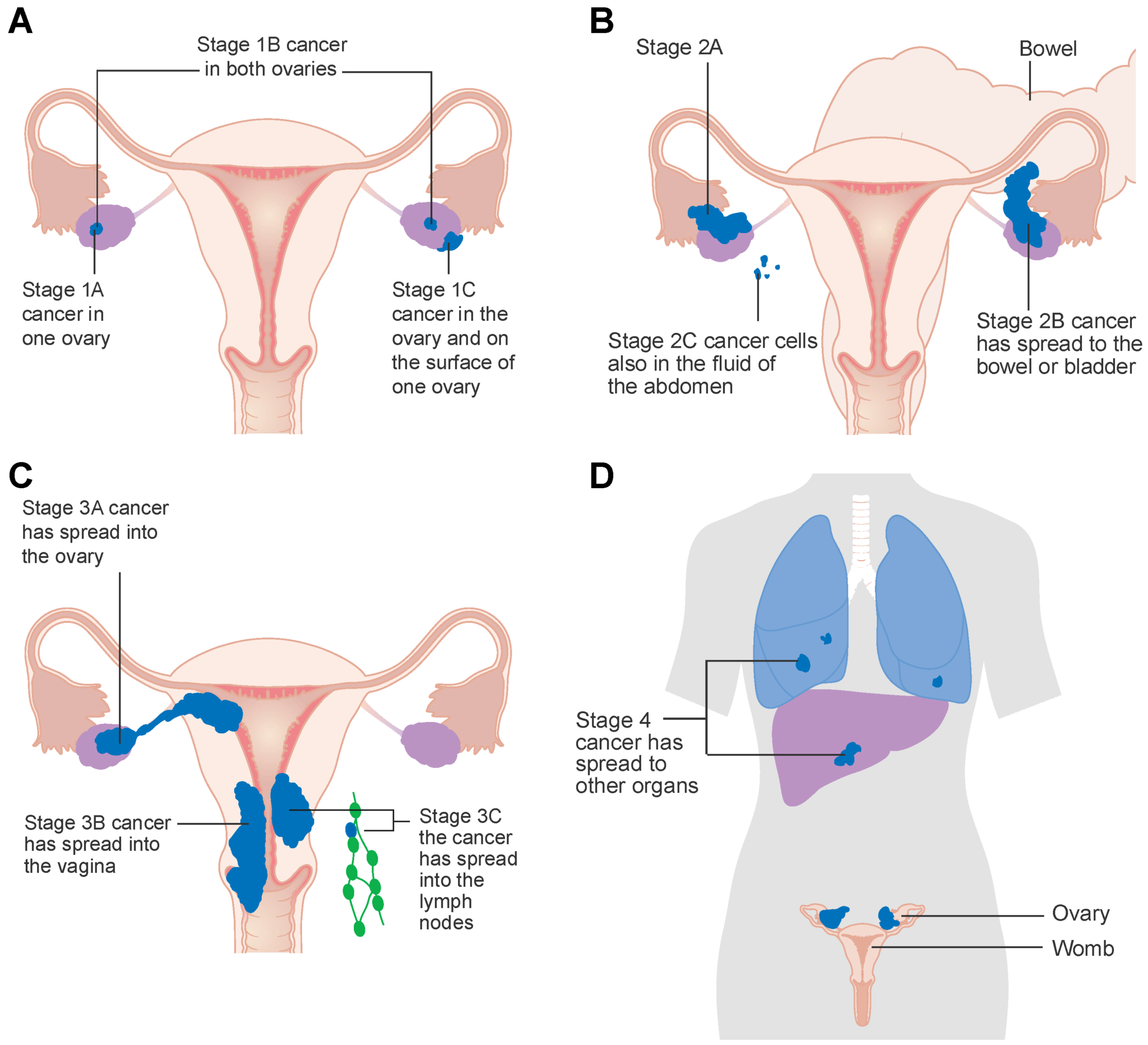 Can Ovarian Cancer Cause Back And Leg Pain