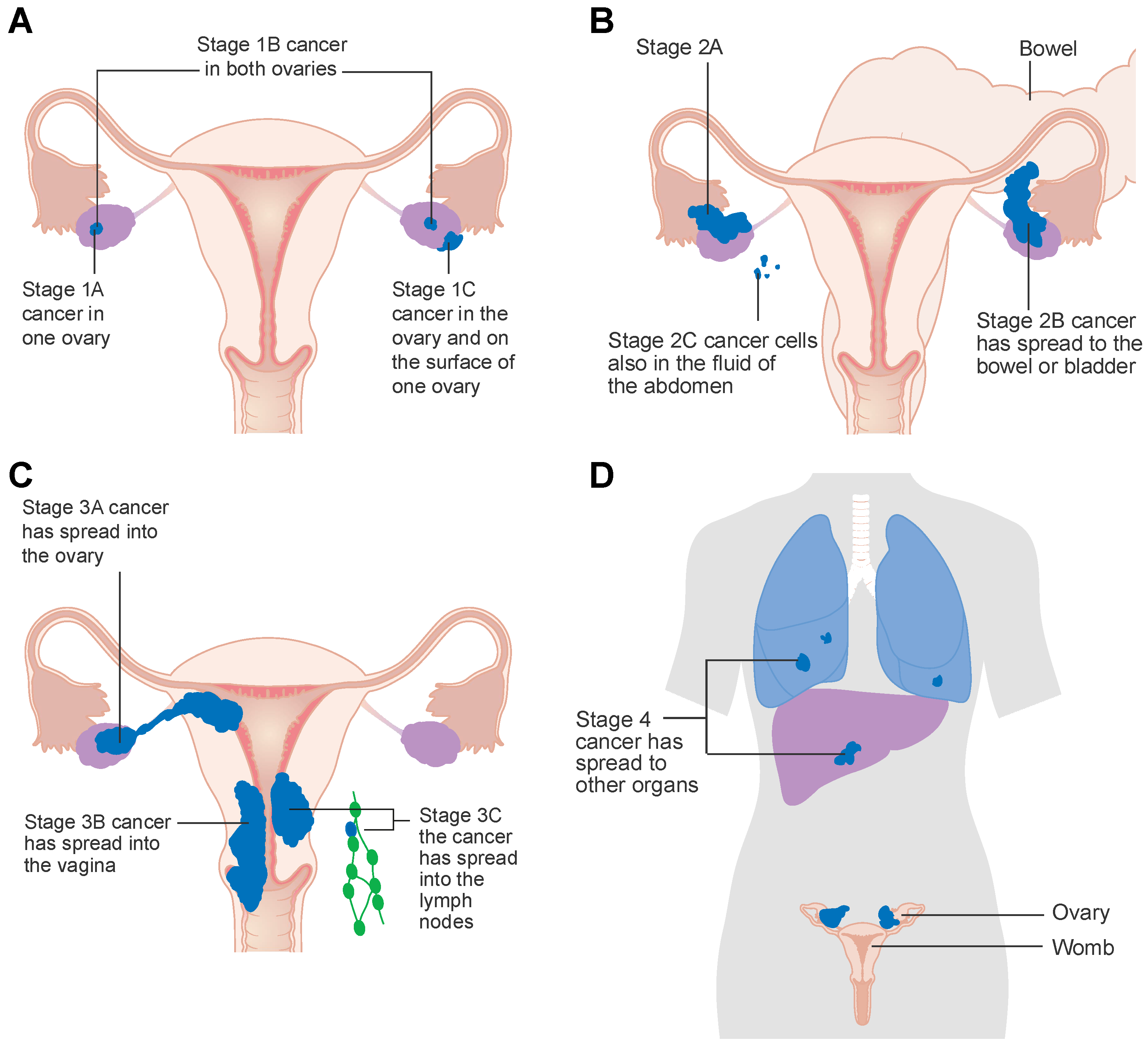 Ovarian Cancer Basics Clearity Foundation