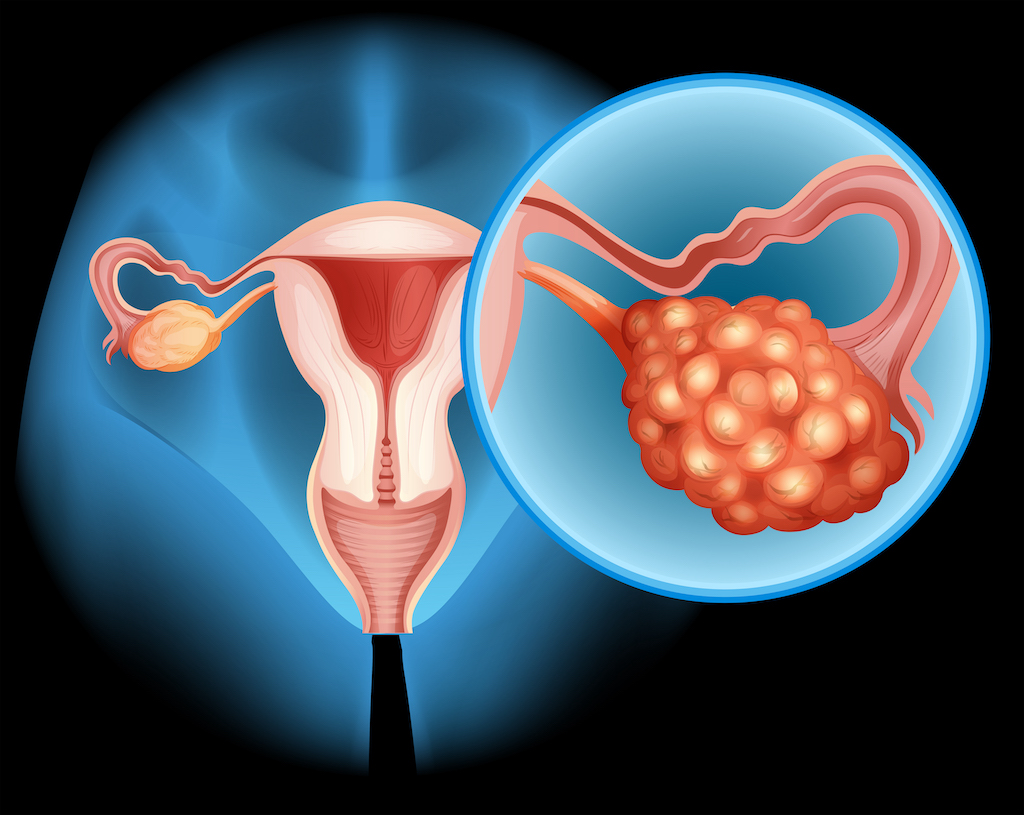 addition-of-bevacizumab-to-pembrolizumab-improves-responses-in