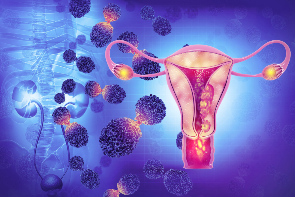 Mirvetuximab Soravtansine Continues To Outperform Chemo In FRα-High ...