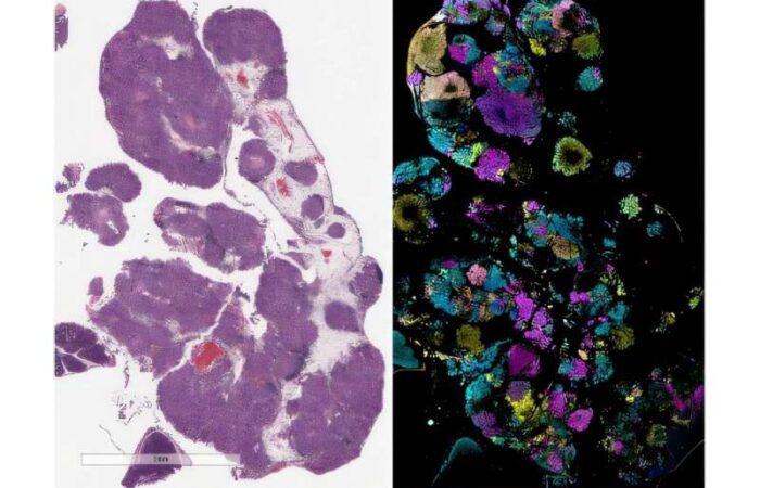 Perturb-map spatial genomics reveals the genes helping tumors grow and resist immunotherapy. The left image shows ovarian tumors in mice tissue, while the right image, enhanced by advanced technology, highlights tumors with different gene changes in various colors. This helped the Mount Sinai team identify which genes protect tumors from the immune system. Credit: Mollaoglu et al., Cell