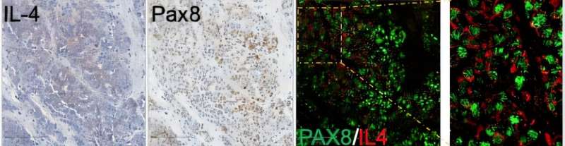 Histological image of an ovarian cancer patient's tumor analyzed for IL-4. Cancer cells expressing the gene PAX8 (green) also show IL-4 expression (red), which was found to help protect the cancer cells from the immune system. Credit: Mollaoglu et al., Cell